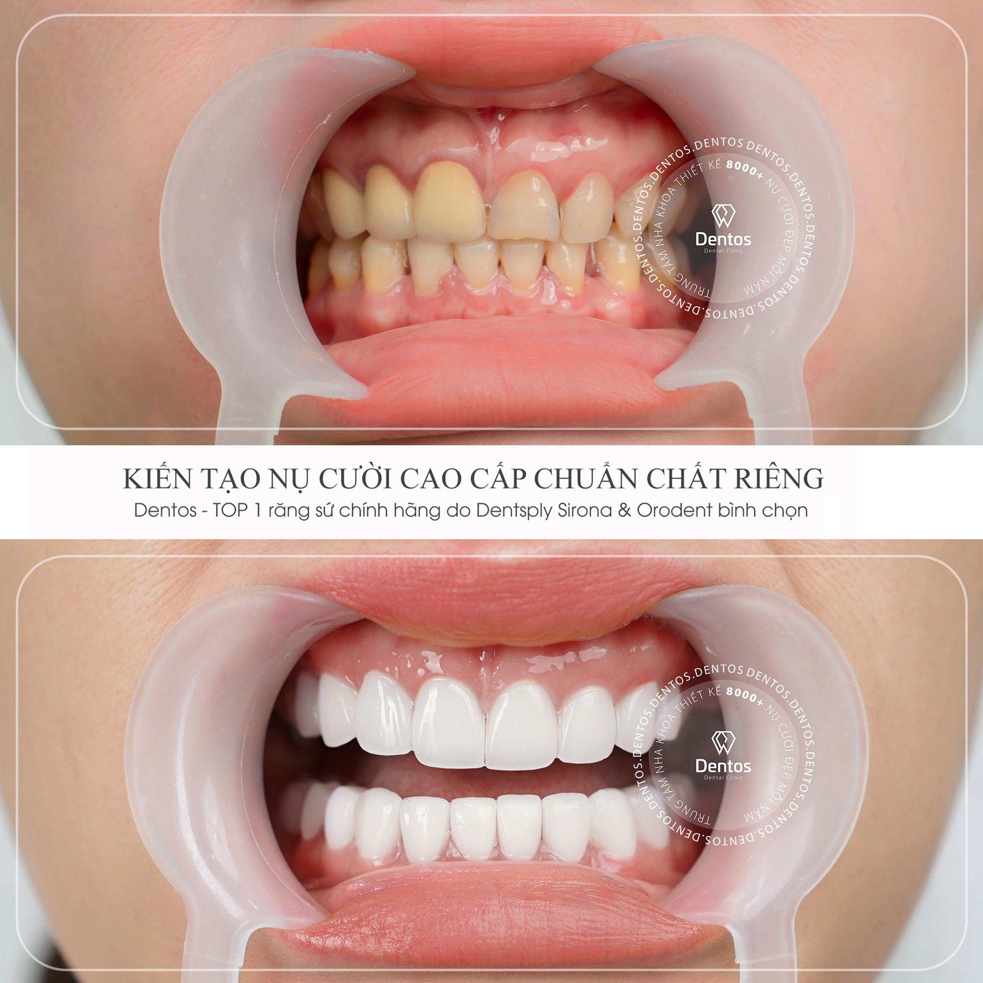 Bọc răng sứ chất lượng tránh các vấn đề răng miệng, cải thiện thẩm mỹ